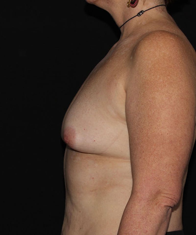 Sientra Breast Implants Before & After Gallery - Patient 133023594 - Image 9
