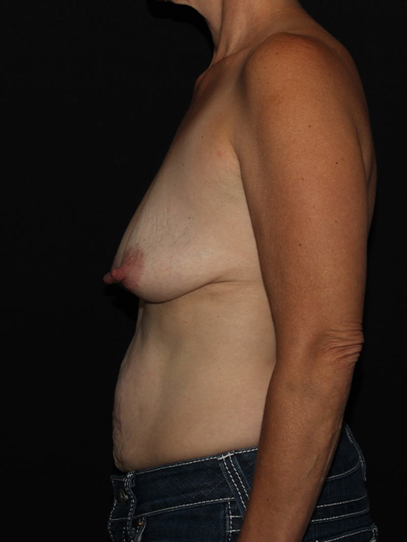Breast Lift with Implants Before & After Gallery - Patient 133023595 - Image 7