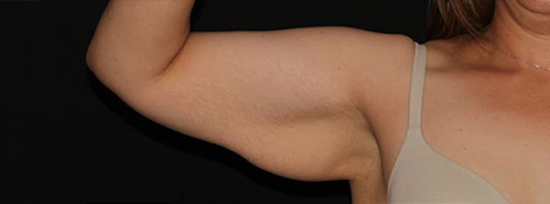 Arm Lift Before & After Gallery - Patient 133023596 - Image 5
