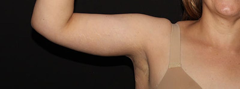 Arm Lift Before & After Gallery - Patient 133023596 - Image 6