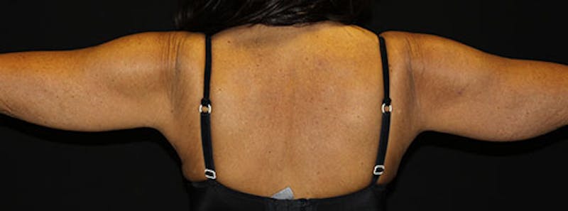 Arm Lift Before & After Gallery - Patient 133023600 - Image 3