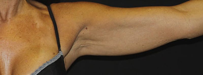 Arm Lift Before & After Gallery - Patient 133023600 - Image 5