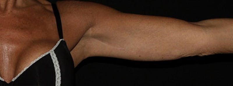 Arm Lift Before & After Gallery - Patient 133023600 - Image 6