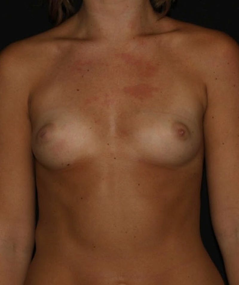 Sientra Breast Implants Before & After Gallery - Patient 133023628 - Image 1