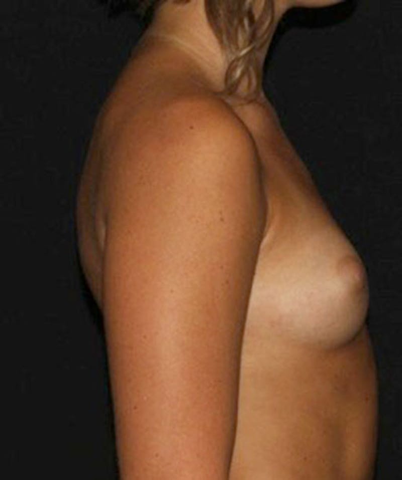 Sientra Breast Implants Before & After Gallery - Patient 133023628 - Image 5