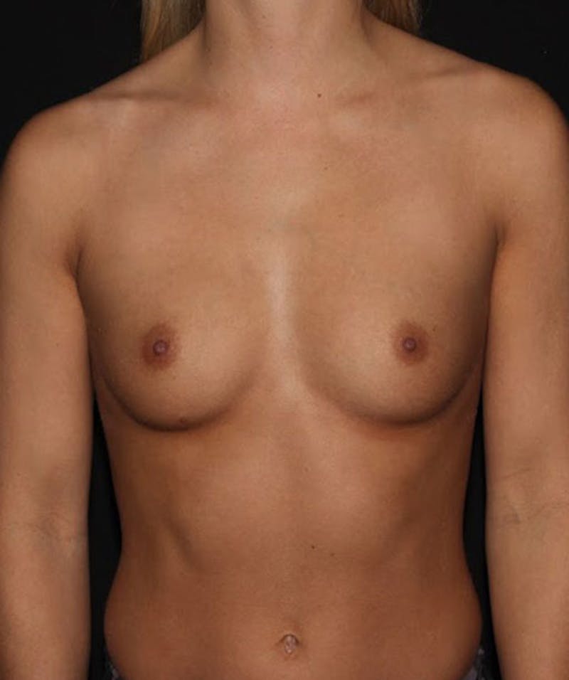 Breast Augmentation Before & After Gallery - Patient 133023637 - Image 1