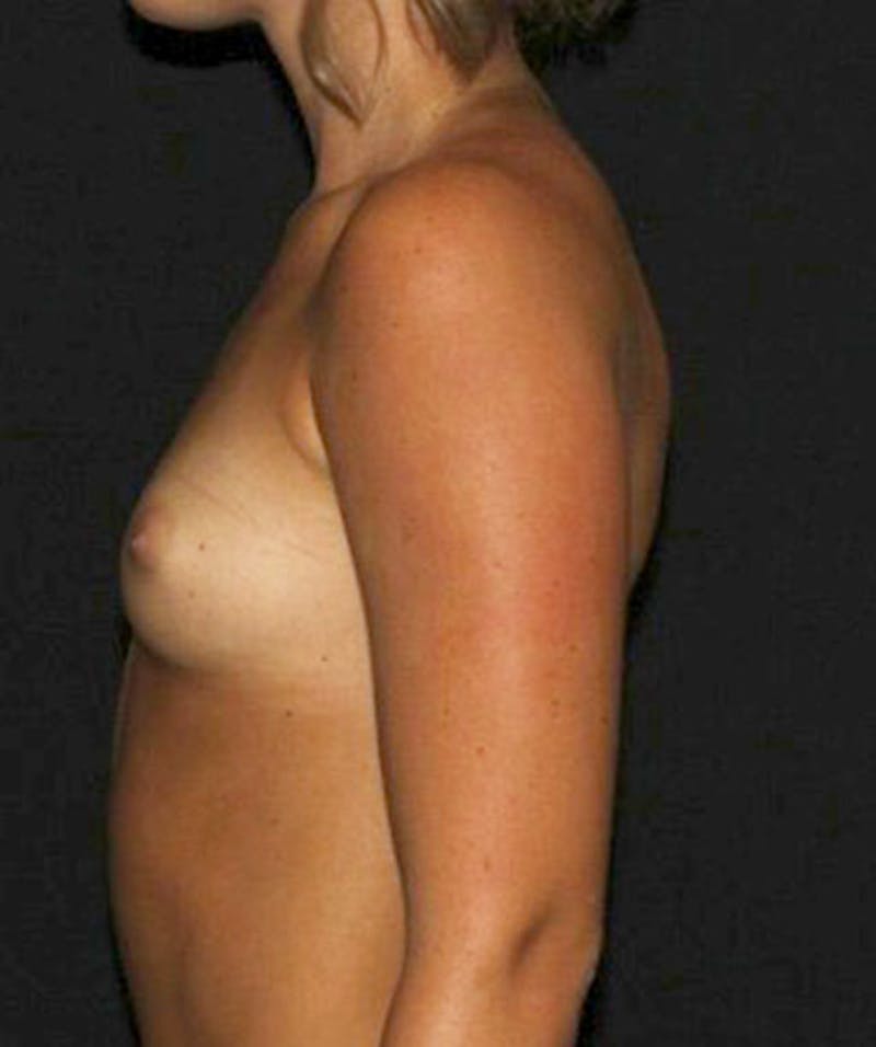 Sientra Breast Implants Before & After Gallery - Patient 133023628 - Image 9