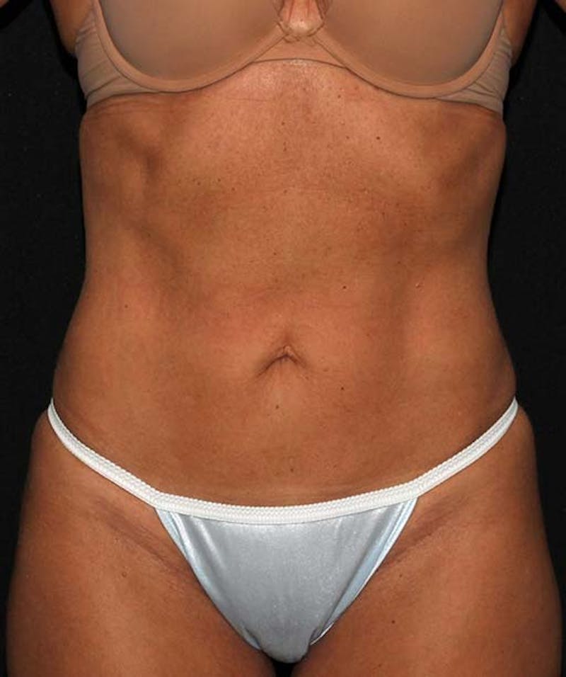 Liposuction Before & After Gallery - Patient 133023640 - Image 2