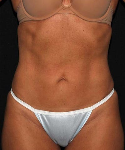 Liposuction Before & After Gallery - Patient 133023640 - Image 2