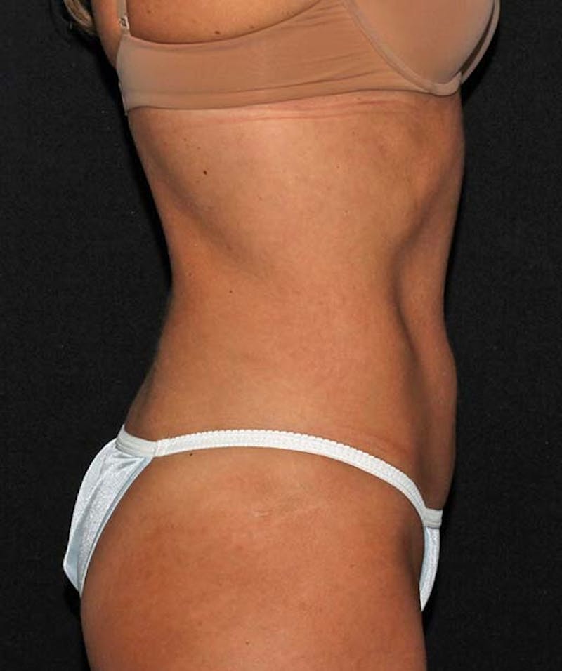 Liposuction Before & After Gallery - Patient 133023640 - Image 6