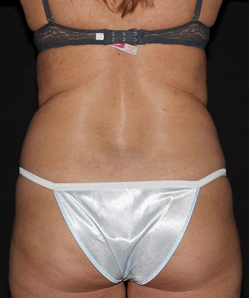 Liposuction Before & After Gallery - Patient 133023640 - Image 7