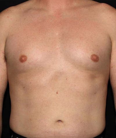 Liposuction Before & After Gallery - Patient 133023648 - Image 1