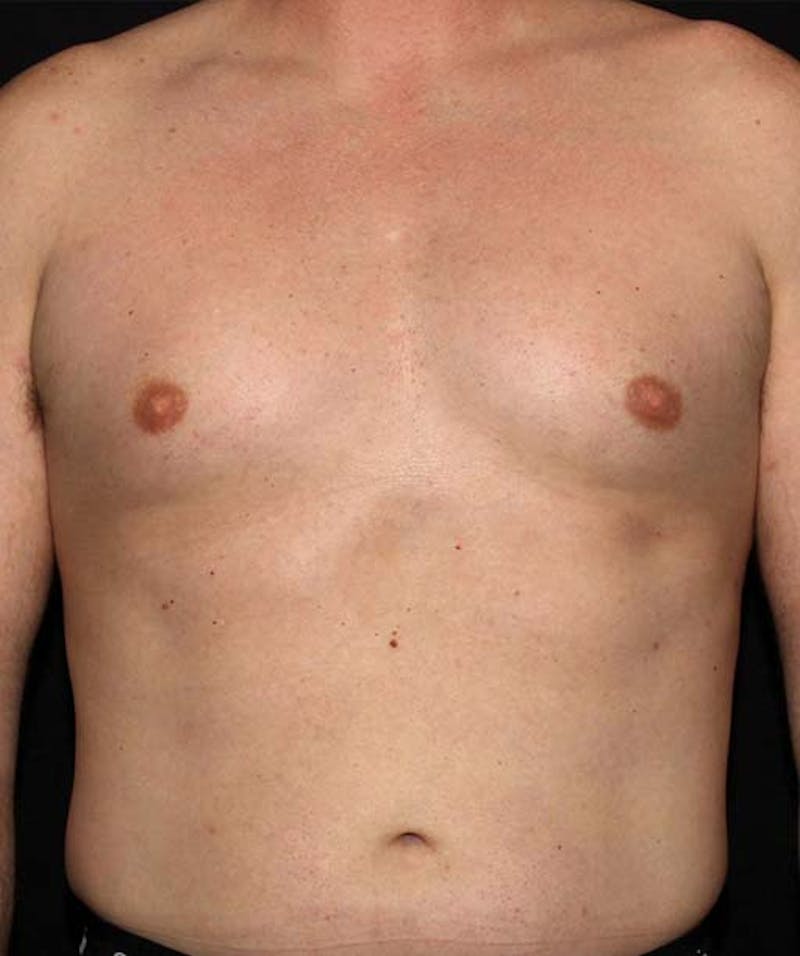 Liposuction Before & After Gallery - Patient 133023648 - Image 1