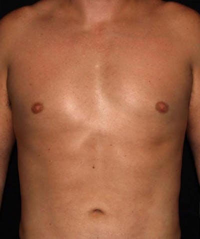 Liposuction Before & After Gallery - Patient 133023648 - Image 2