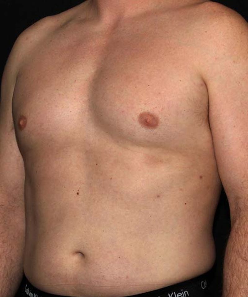 Liposuction Before & After Gallery - Patient 133023648 - Image 3