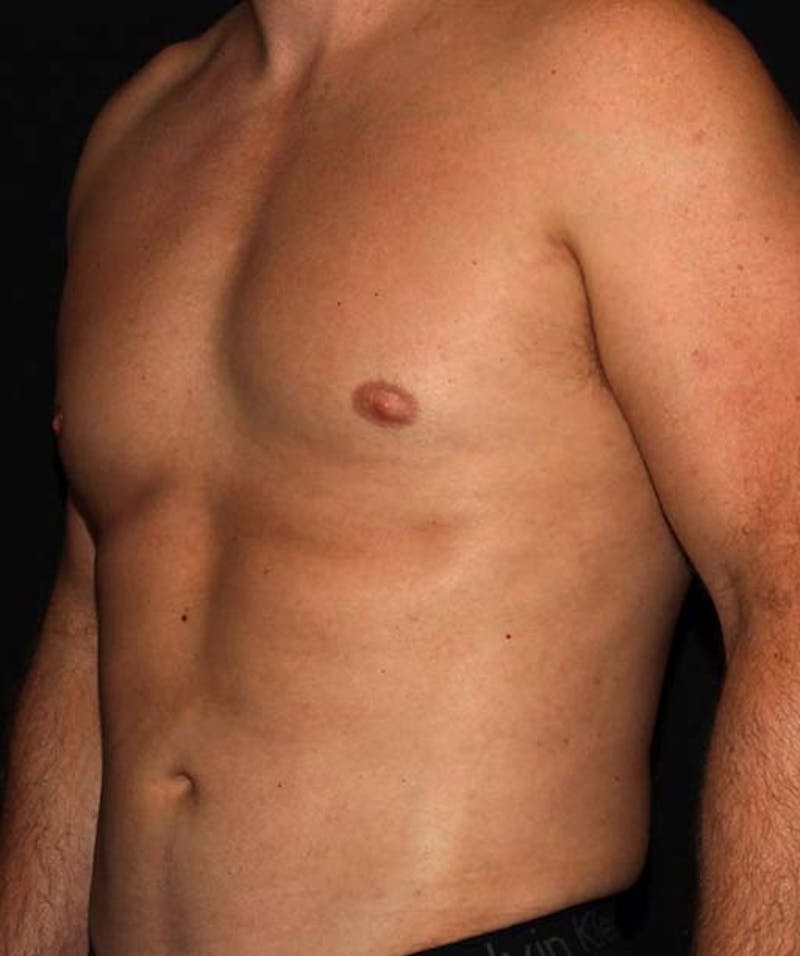 Liposuction Before & After Gallery - Patient 133023648 - Image 4