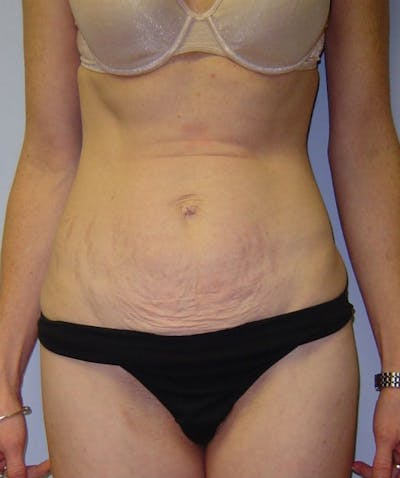 Mini Tummy Tuck Before & After Gallery - Patient 133023651 - Image 1