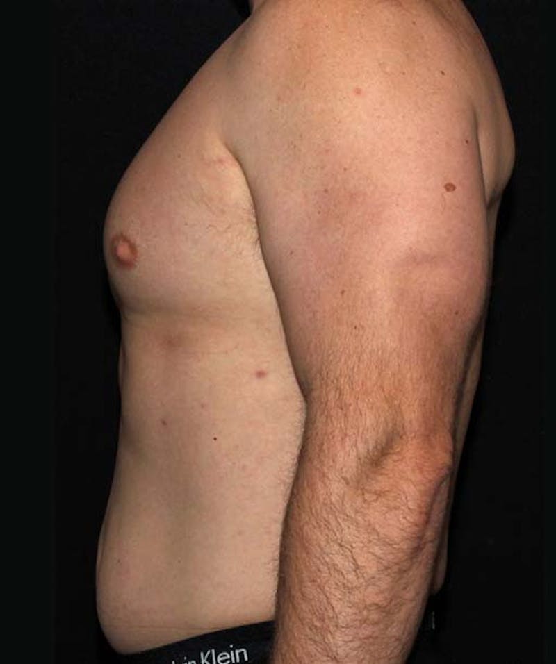 Liposuction Before & After Gallery - Patient 133023648 - Image 5