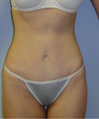 Mini Tummy Tuck Before & After Gallery - Patient 133023651 - Image 2