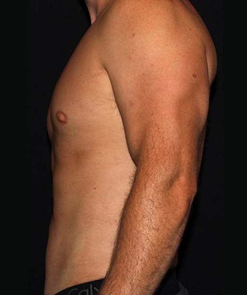 Liposuction Before & After Gallery - Patient 133023648 - Image 6