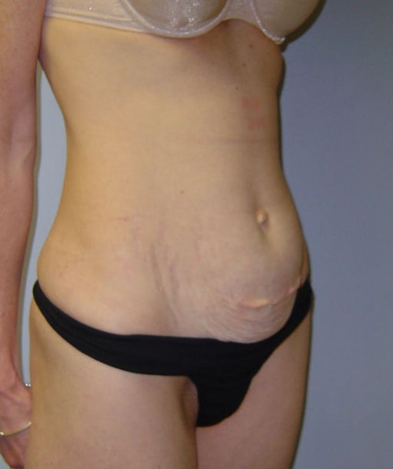 Mini Tummy Tuck Before & After Gallery - Patient 133023651 - Image 3