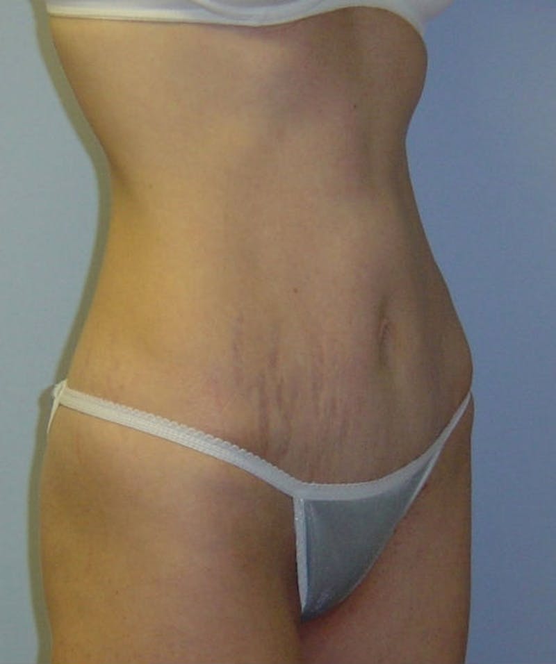 Mini Tummy Tuck Before & After Gallery - Patient 133023651 - Image 4