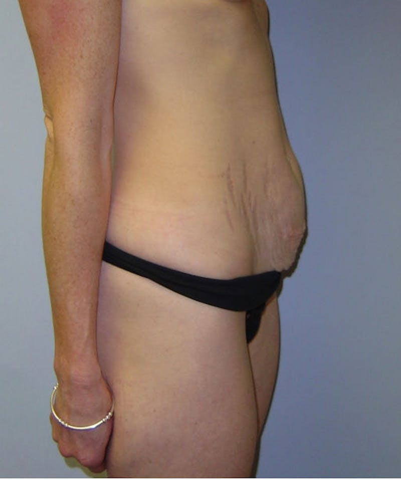 Mini Tummy Tuck Before & After Gallery - Patient 133023651 - Image 5