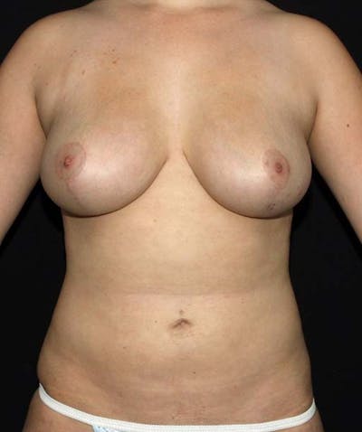 Liposuction Before & After Gallery - Patient 133023660 - Image 2