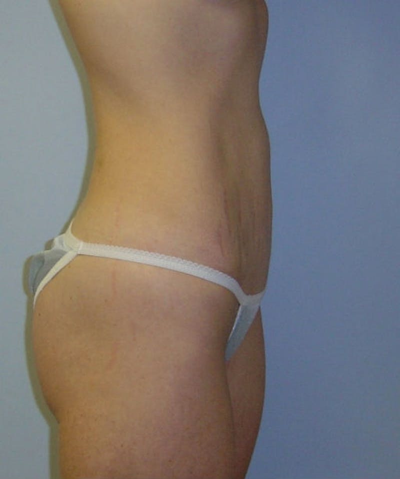 Mini Tummy Tuck Before & After Gallery - Patient 133023651 - Image 6
