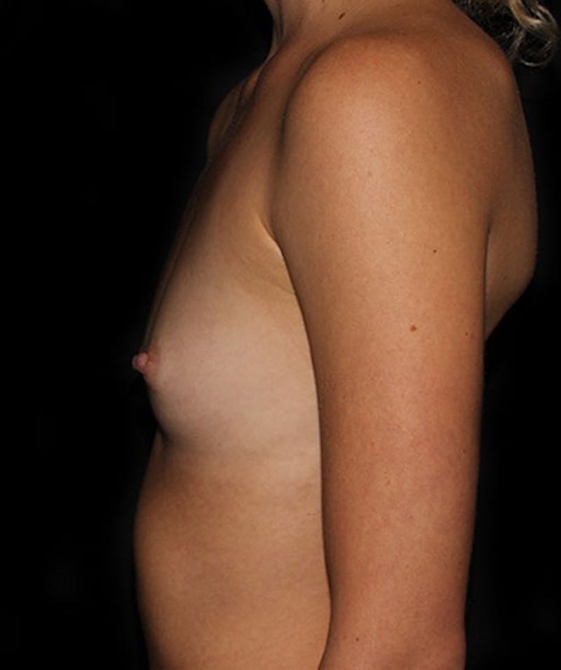 Breast Augmentation Before & After Gallery - Patient 133023652 - Image 5