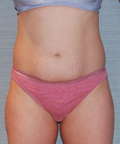 Mini Tummy Tuck Before & After Gallery - Patient 133023656 - Image 1
