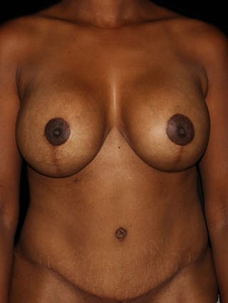 Mommy Makeover Before & After Gallery - Patient 133023654 - Image 2