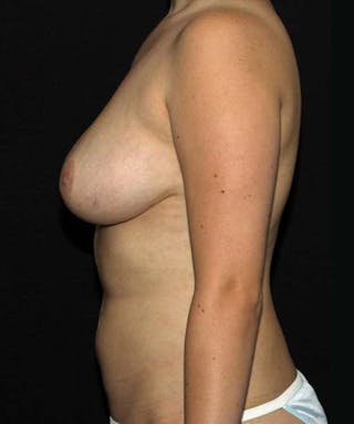 Liposuction Before & After Gallery - Patient 133023660 - Image 6