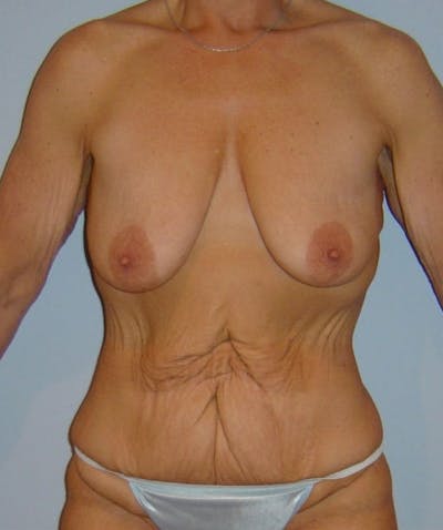 Post Weight Loss Surgery Before & After Gallery - Patient 133023658 - Image 1