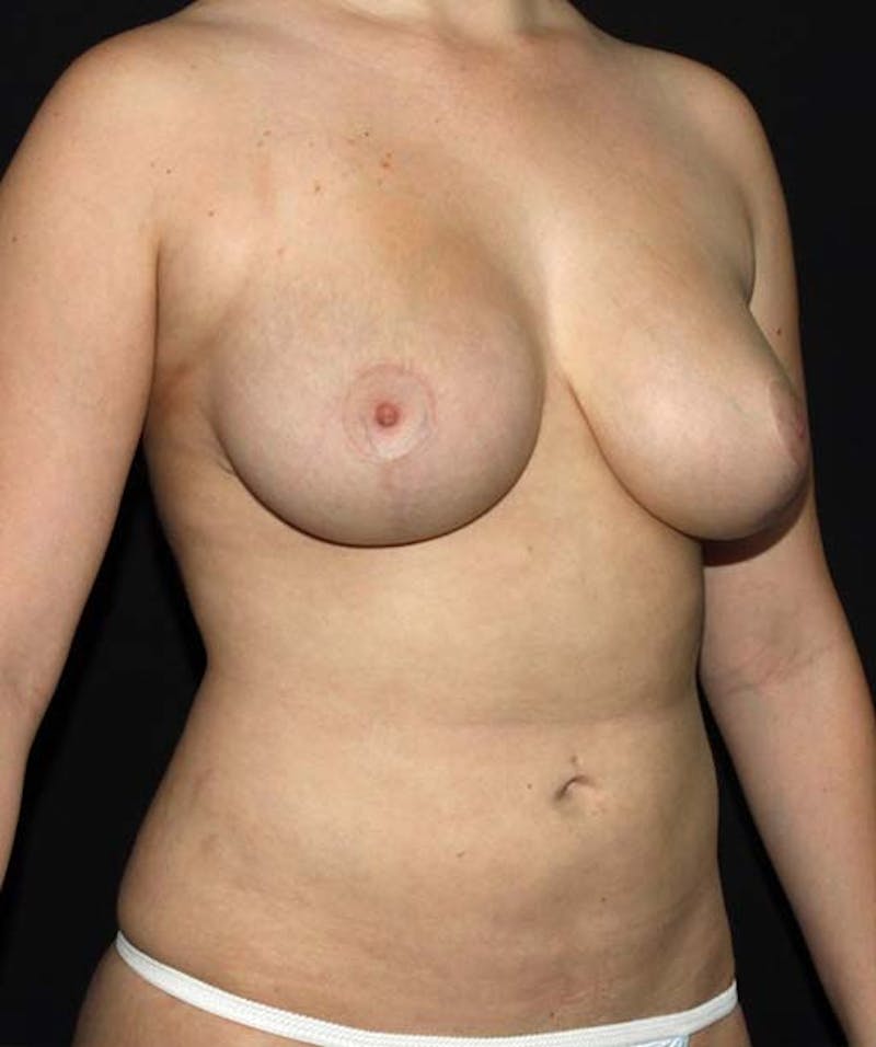 Liposuction Before & After Gallery - Patient 133023660 - Image 8