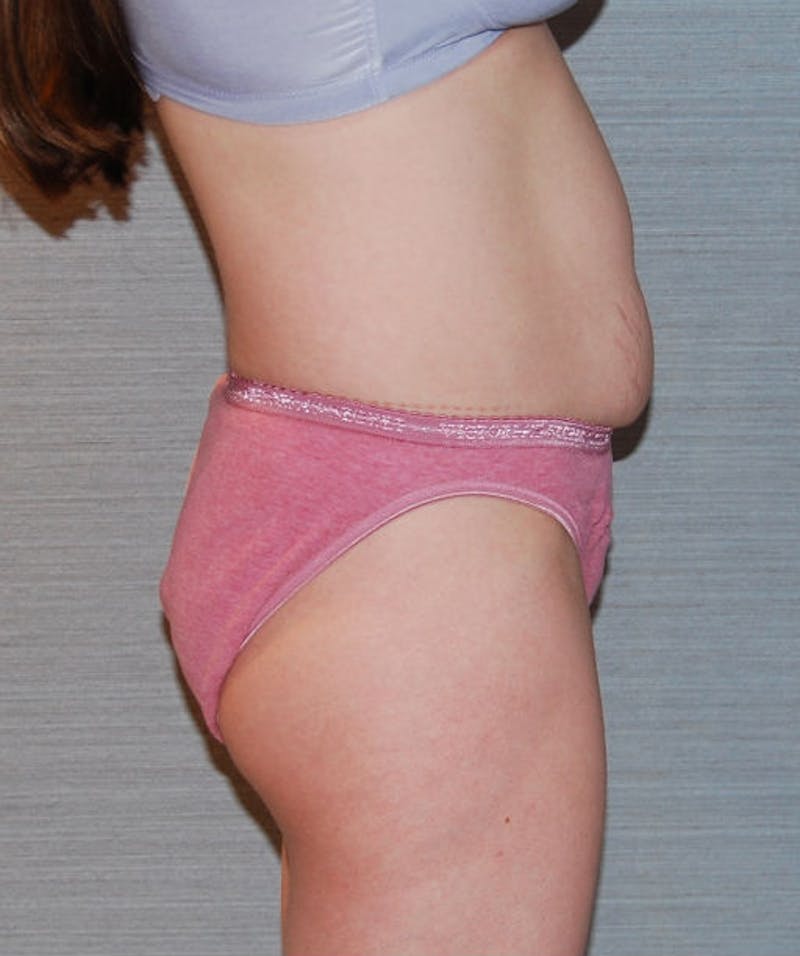 Mini Tummy Tuck Before & After Gallery - Patient 133023656 - Image 5