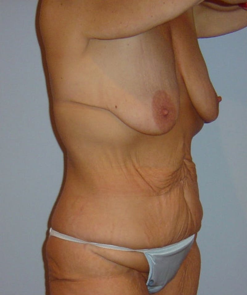 Post Weight Loss Surgery Before & After Gallery - Patient 133023658 - Image 3
