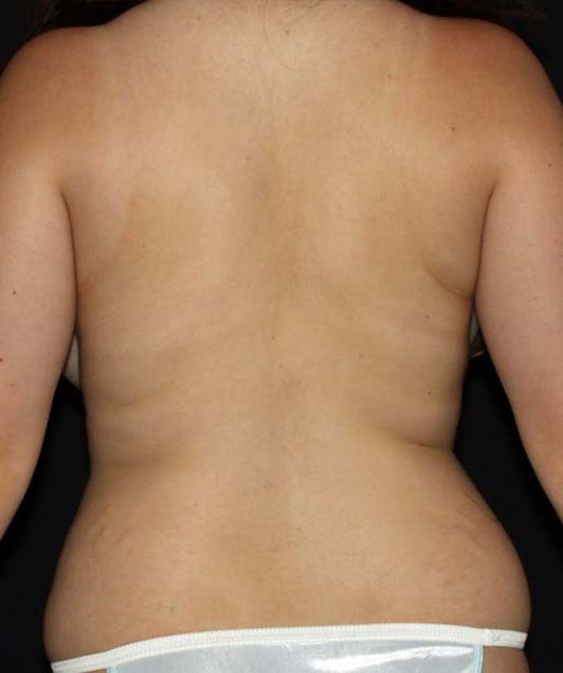 Liposuction Before & After Gallery - Patient 133023660 - Image 11