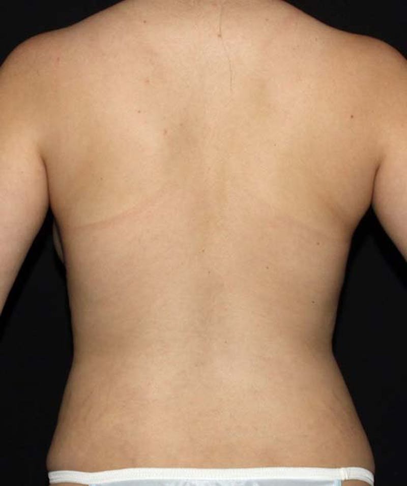 Liposuction Before & After Gallery - Patient 133023660 - Image 12