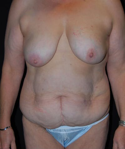 Post Weight Loss Surgery Before & After Gallery - Patient 133023665 - Image 1