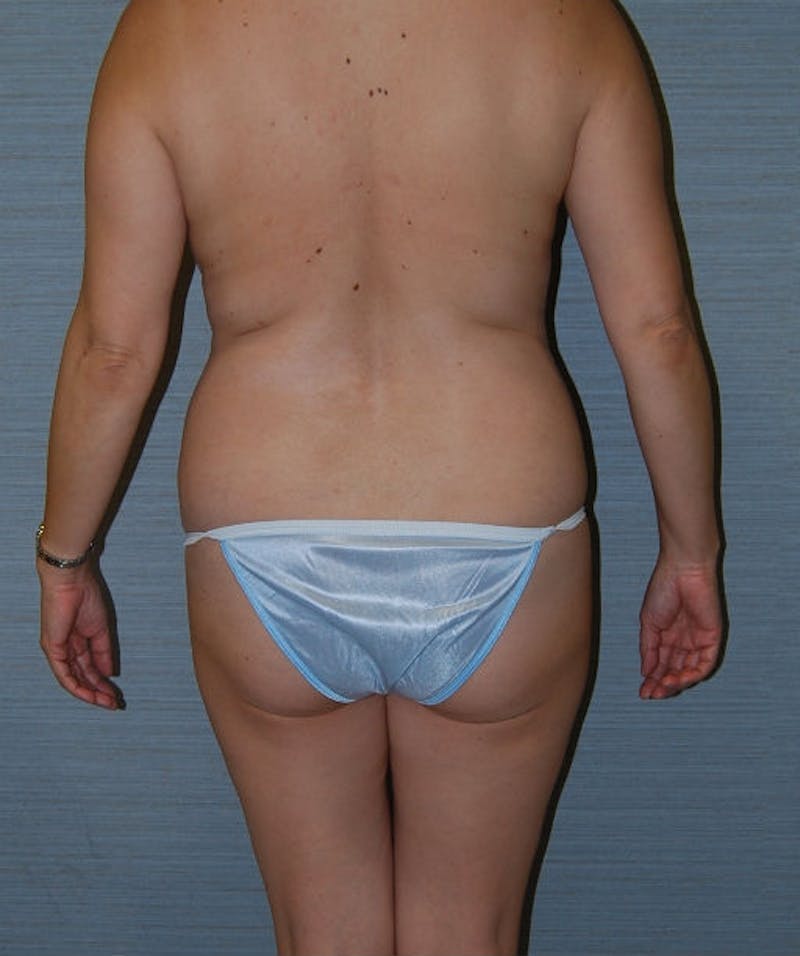 Mini Tummy Tuck Before & After Gallery - Patient 133023664 - Image 5