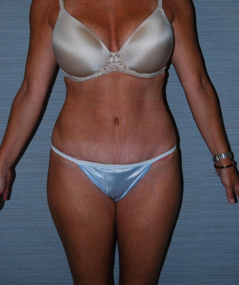 Tummy Tuck Before & After Gallery - Patient 133023672 - Image 2