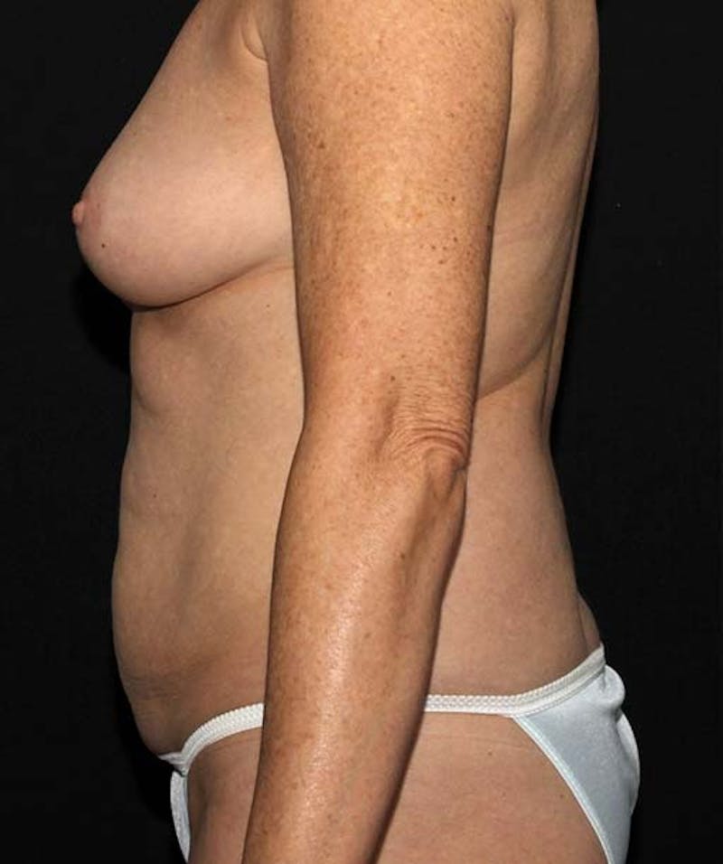 Liposuction Before & After Gallery - Patient 133023670 - Image 5