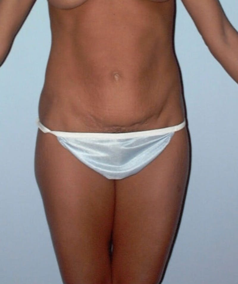 Mini Tummy Tuck Before & After Gallery - Patient 133023666 - Image 1