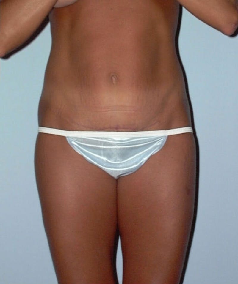 Mini Tummy Tuck Before & After Gallery - Patient 133023666 - Image 2