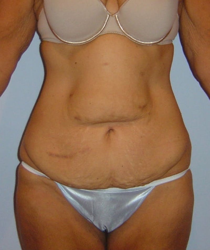 Post Weight Loss Surgery Before & After Gallery - Patient 133023680 - Image 1