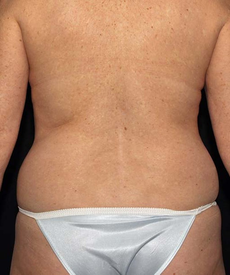 Liposuction Before & After Gallery - Patient 133023670 - Image 7