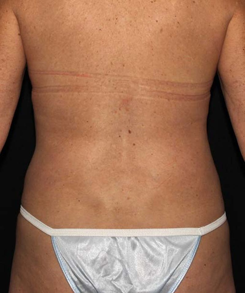 Liposuction Before & After Gallery - Patient 133023670 - Image 8