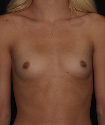 Breast Augmentation Before & After Gallery - Patient 133023683 - Image 1