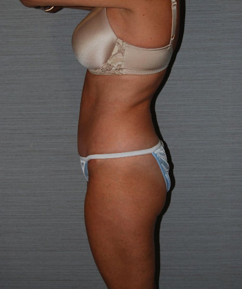 Tummy Tuck Before & After Gallery - Patient 133023672 - Image 6